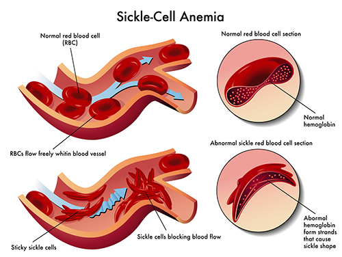 Sickle Cell post thumbnail image